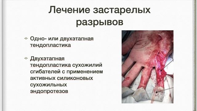 28. Повреждения сухожилий сгибателей и разгибателей пальцев кисти: диагностика,принципы лечения. смотреть онлайн