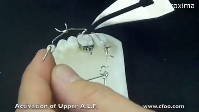 Аппарат "лёгких сил" ALF. Ортодонтия.