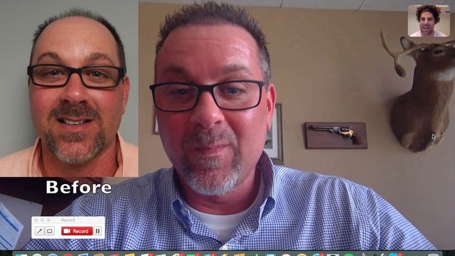 Hair Transplant Before and After | Hair Transplant Before and After Videos (Robert) смотреть онлайн