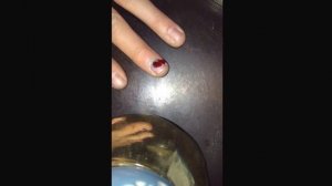 What to do if you bruised your nail.