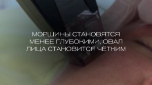 Микроигольчатый RF-лифтинг Morfeus8 и Fractora на платформе Inmode