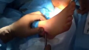 Операция артроэрез 3