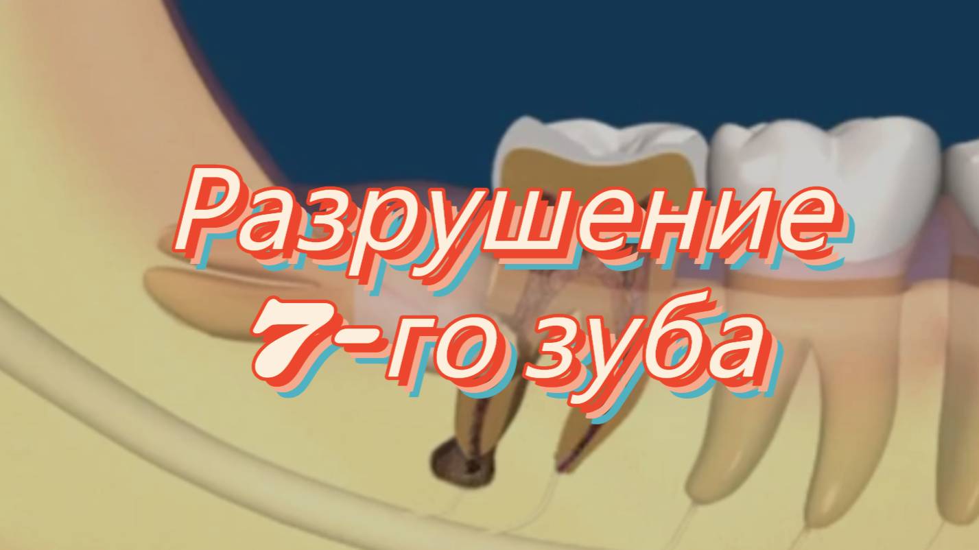 ⚡️ Разрушение 7-го зуба