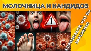 Молочница и Кандидоз | 5 ПРИЗНАКОВ, что вы заражены!