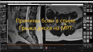 Причины боли в спине. Грыжа диска на МРТ. Что видит МРТ.