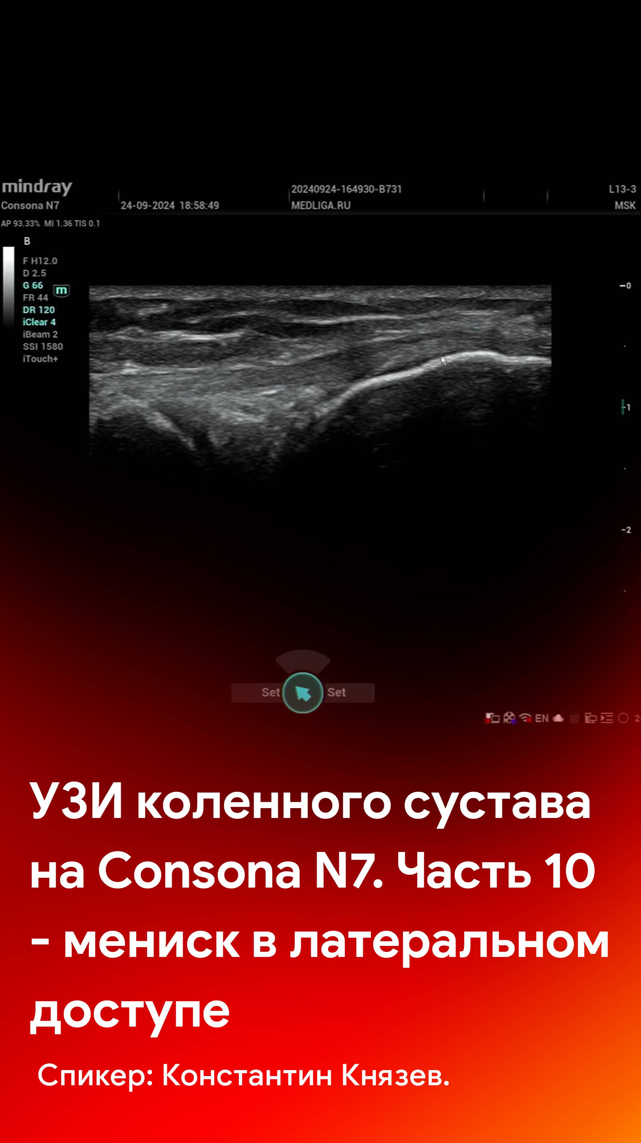 УЗИ коленного сустава на Mindray Consona N7. Часть 10 - мениск в латеральном доступе