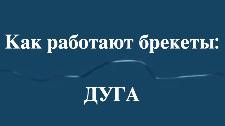 🛠 Как работают брекеты: дуга