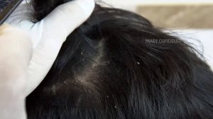 Dandruff Scratching Big Flakes Satisfying #656