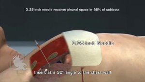 Декомпрессионная игла для оказания помощи при напряженном пневмотораксе ARS for Needle Decompression