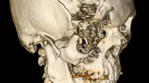 Краниопластика индивидуальной титановой пластиной пациенту после тяжелого ДТП