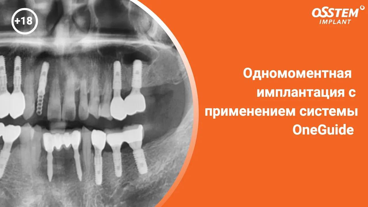 Одномоментная имплантация с применением системы OneGuide