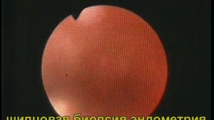 Рак эндометрия. Гистероскопия. Биопсия.
