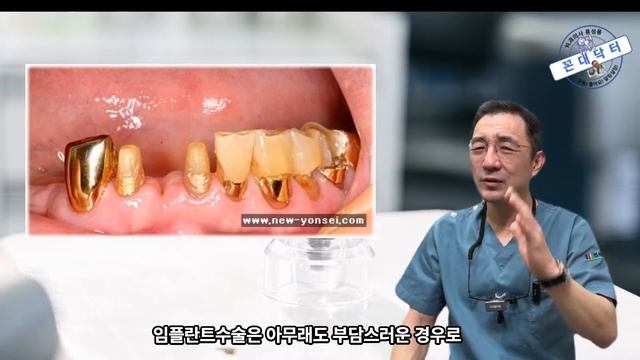 치아 상실했을 때 임플란트 보다 브릿지 보철 치료가 더 좋은 경우들 6가지