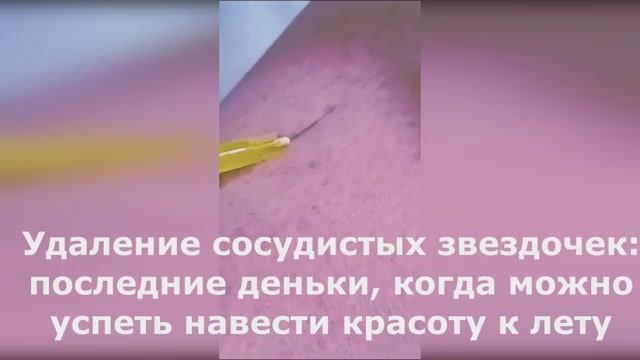 Микросклеротерапия: успеть до лета!! Хотите красивые ножки? после дние деньки!