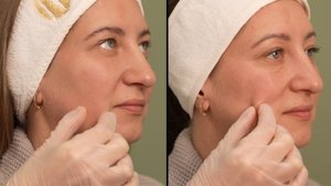 Результат после процедуры Endolift Безоперационная подтяжка лица