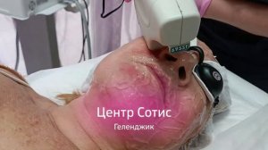 Фотоомоложение Sciton BBL в Сотис Геленджик