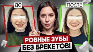 Ровные зубы без брекетов, ДО и ПОСЛЕ