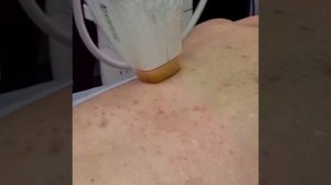 Лечение акне