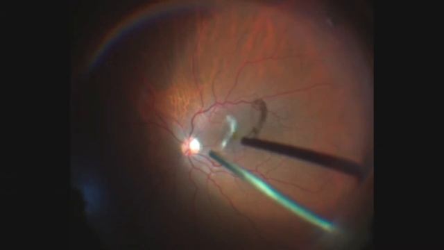 Innovative solutions for HD / 4K surgical video recording using commercial Mirror-less cameras.