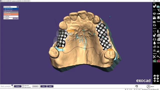 EXOCAD PARTIALCAD Моделировка Бюгельного протеза смотреть онлайн