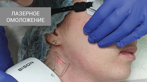Лазерное омоложение в клинике Артевита