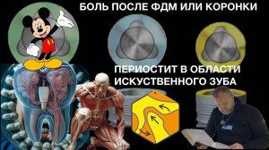 Периостит при установке коронки на имплантате