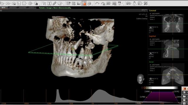 LECTURA DE TOMOGRAFÍA ODONTOLÓGICA VATECH Ez 3D-i Simple Viewer смотреть онлайн