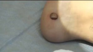 Удаление бородавки на стопе