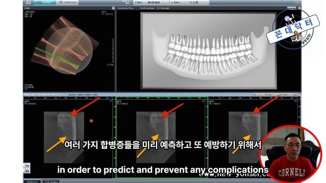 누워서 잘못난 부분매복 사랑니 수술발치 과정, surgical extraction of the wisdom tooth