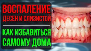Воспаление во рту. Как быстро снять воспаление десен и слизистой оболочки дома?