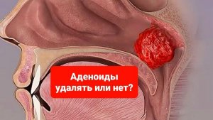 У ребёнка аденоиды?удалять их или нет?