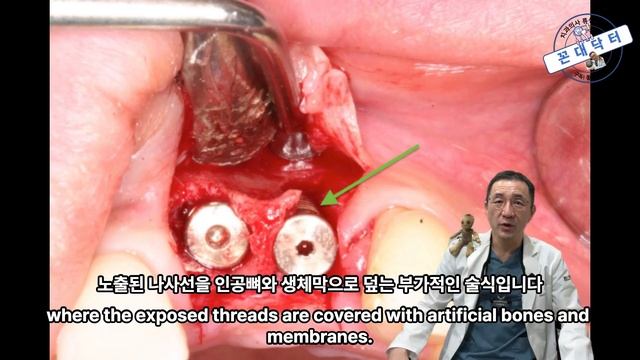 치과 임플란트에 수술에 뼈이식이 꼭 필요한걸까? 치조골이식술이 꼭 필요한 경우