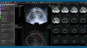 Фьюжн-биопсия предстательной железы – верное решение для пациента!