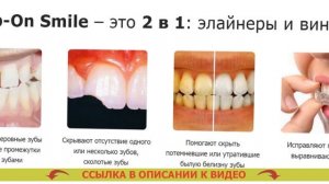 😬 Стоимость установки виниров на зубы в москве 👄