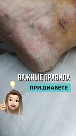 Простые, но очень важные шаги для защиты стоп 👣 при диабете