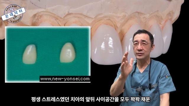 앞니 크라운 1개만으로 인상을 확 개선할 수 있어야 명의이자 양심 치과의사