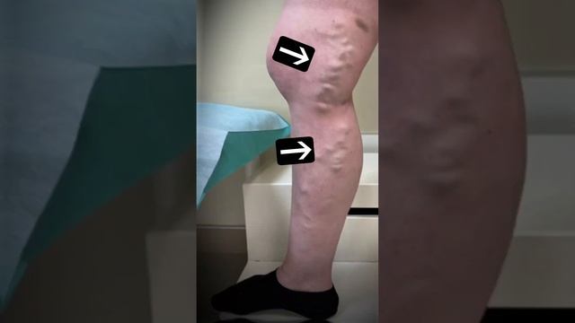 Пиявки при варикозе? Можно или нет?