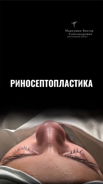 Больше работ на моём канале. Подписывайтесь! #ринопластика #риносептопластика #пластиканоса