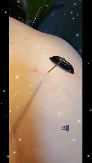 гирудотерапия + рефлексотерапия смотреть онлайн