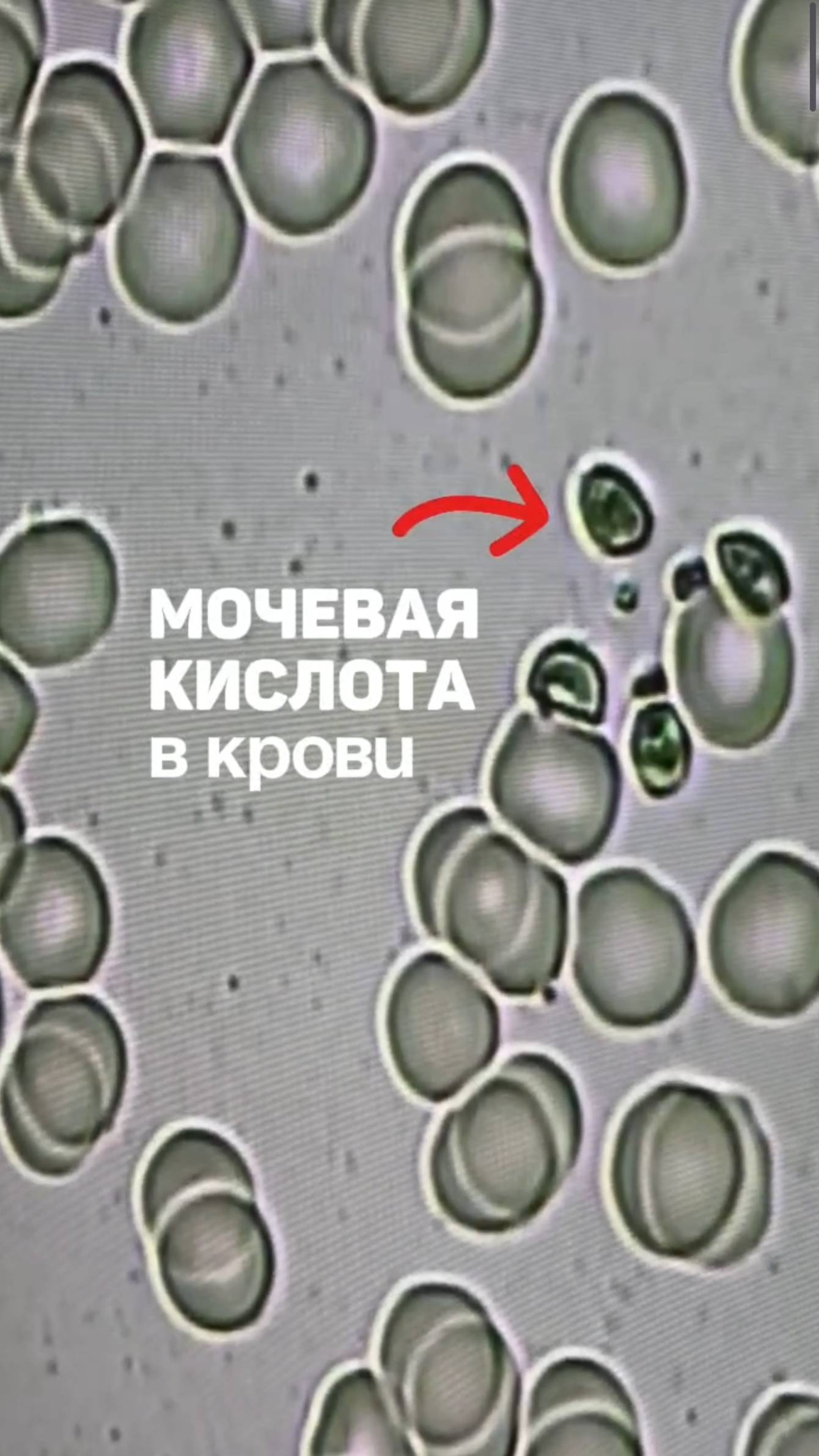 Мочевая кислота. Хруст в суставах, артроз и остеохондроз, камни в почках