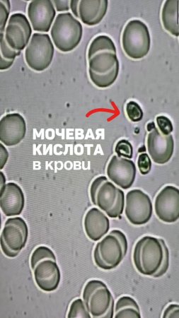 Мочевая кислота. Хруст в суставах, артроз и остеохондроз, камни в почках