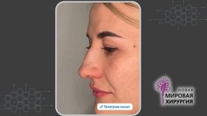 Повторная ринопластика и удаление невуса