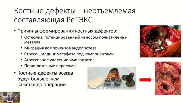 "Планирование ревизионного эндопротезирования коленного сустава."