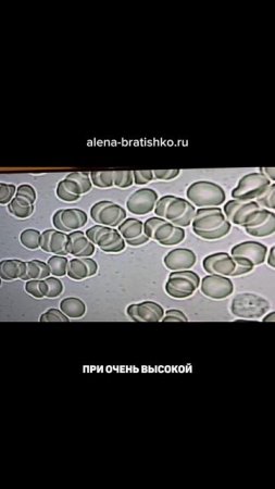 Так выглядит под микроскопом капля крови онкобольного. Алена Братишко
