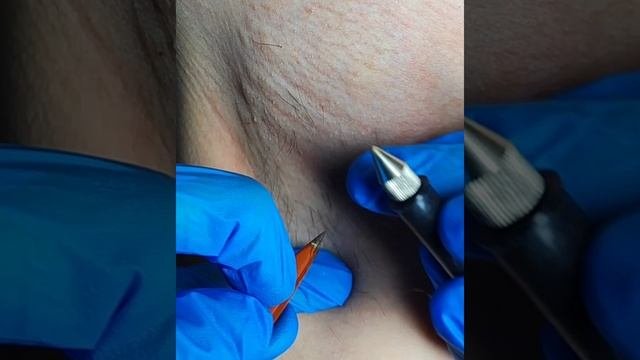 Электроэпиляция подмышечных впадин