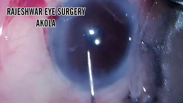 SIEPSER SLIDING KNOT FOR CLOSURE OF IRIS DEFECT смотреть онлайн
