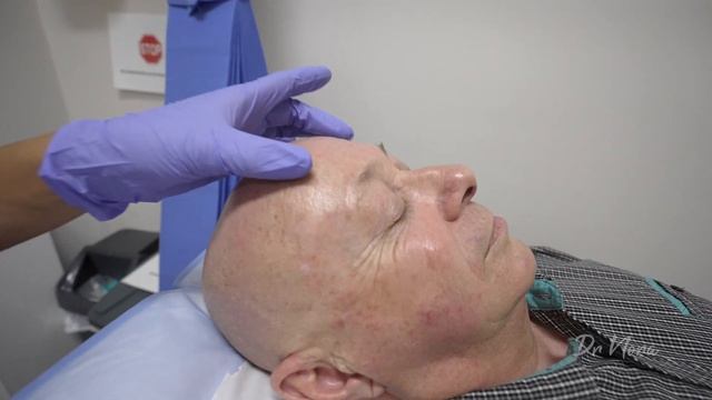 Upper Face Anti-Wrinkle Male Transformation | Full Treatment with Before and After 💉