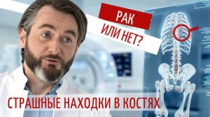 3 пугающих диагноза. Находки в костях после КТ