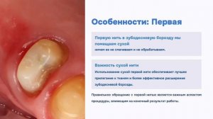 Прокладывание ниток для слепков