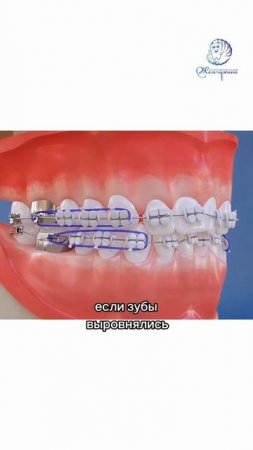 Почему нельзя снять брекеты через полгода?